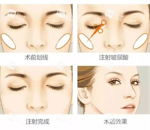 玻尿酸前后注射示意图 玻尿酸前后注射示意图