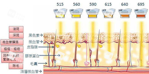 光子嫩肤原理图