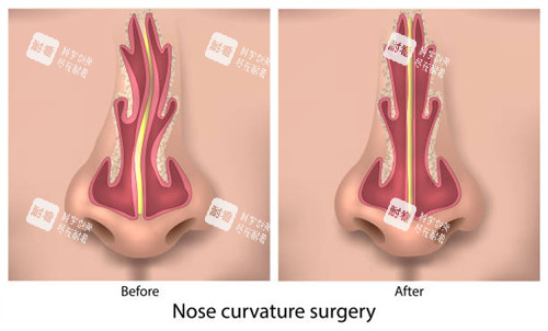 正常鼻子和歪鼻