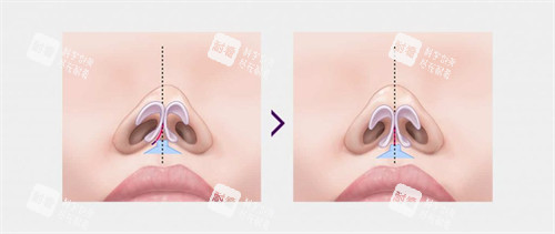 歪鼻和正常鼻子