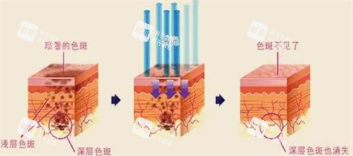激光祛斑前后对比