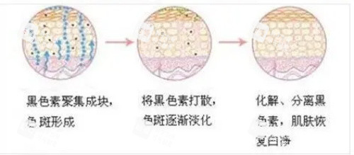 激光祛斑示意图