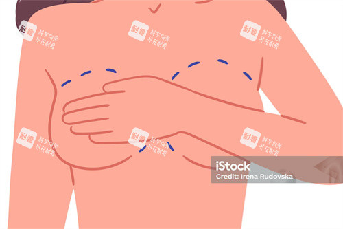 隆胸手术卡通图示