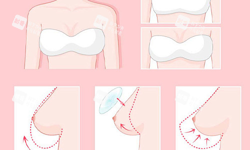 隆胸的流程展示