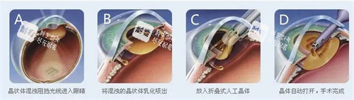 晶体置换手术图片