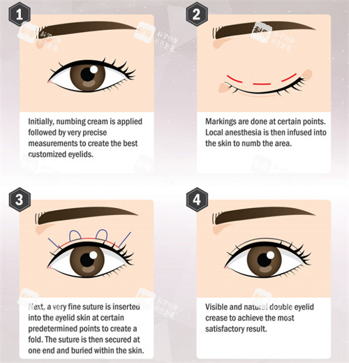 埋线双眼皮手术流程图