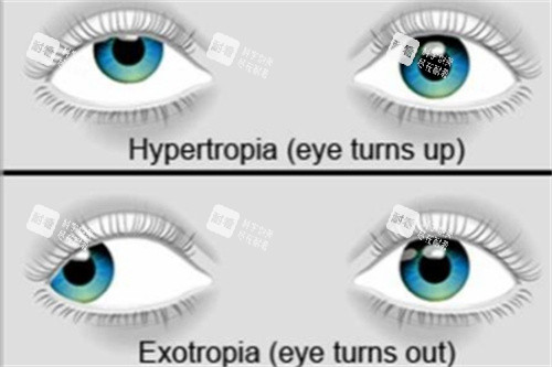 外斜视