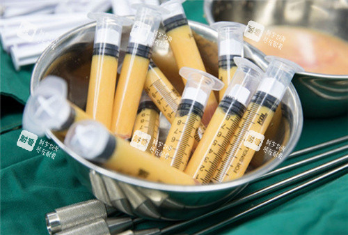 抽取出来的脂肪图示