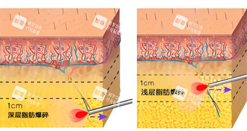 激光溶脂作用皮肤层图