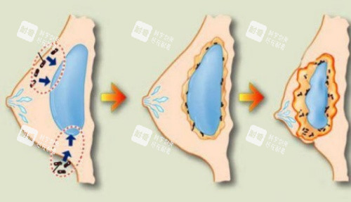 丰胸薄膜挛缩形成示意图