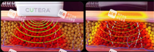 美国既塑3D溶脂操作过程