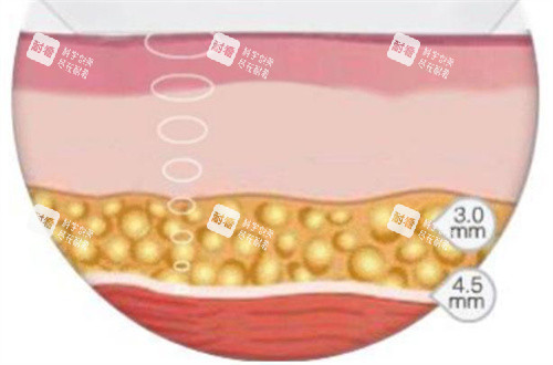 超声波溶脂演示动画图