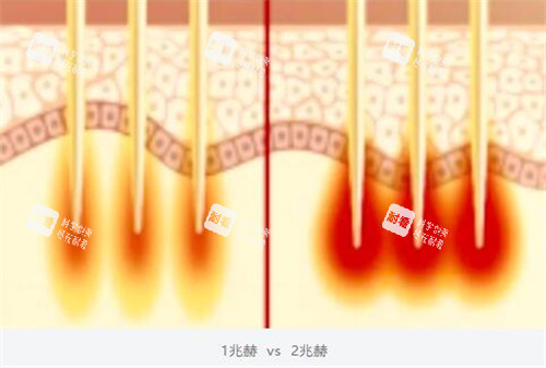 黑曜双波黄金微针双波发射模式