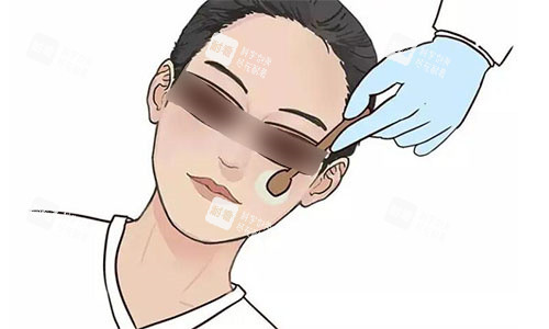 光子嫩肤示意图