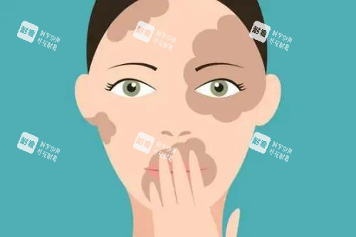 白癜风卡通展示图