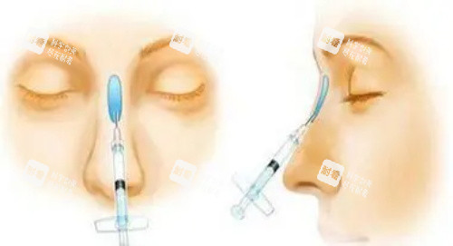玻尿酸注射隆鼻示意图