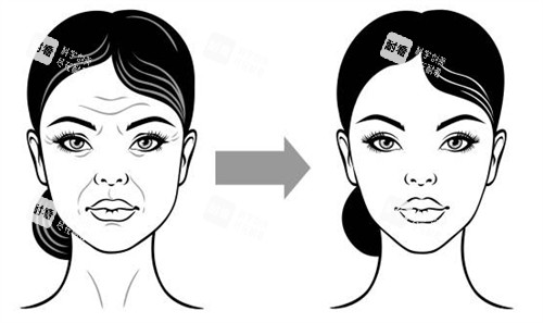 面部提升手术改善面部皱纹 面部提升手术改善面部皱纹