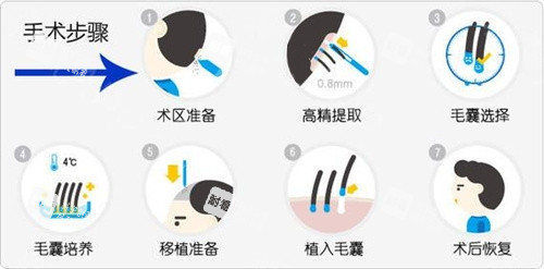 毛发移植手术步骤动画演示图