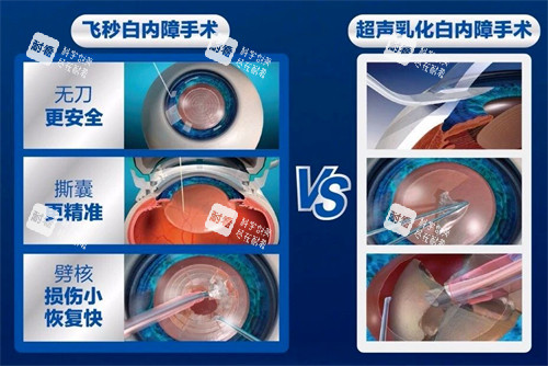 飞秒白内障手术过程 飞秒白内障手术过程