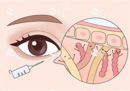眼周抗衰注射卡通图