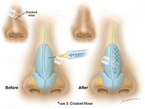 玻尿酸注射隆鼻前后对比 玻尿酸注射隆鼻前后对比