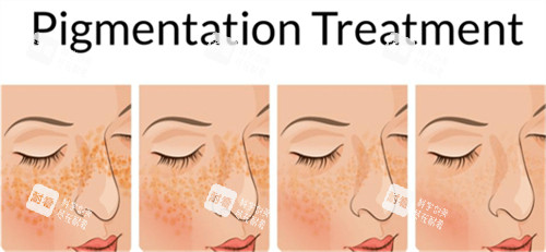 激光祛斑前后皮肤对比 激光祛斑前后皮肤对比