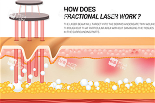 激光在皮肤中祛斑 激光在皮肤中祛斑
