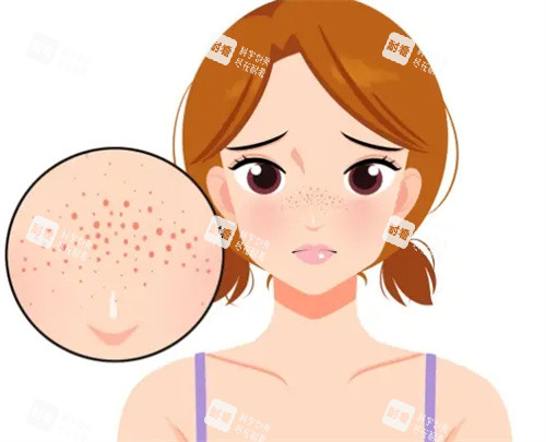 祛斑卡通图片