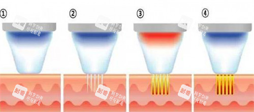 黄金微针施术步骤介绍