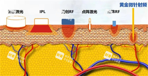 黄金微针射频层次