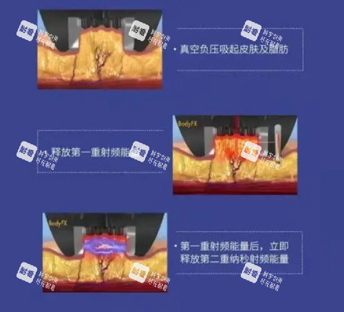 钻石超塑整形的优势示意图