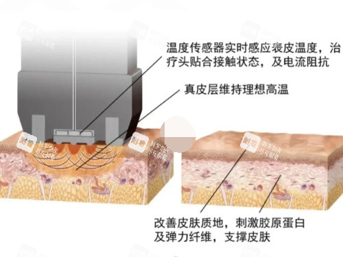 钻石超塑整形原理示意图