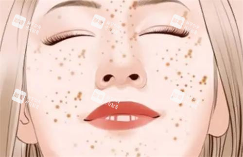 脸部有祛雀斑的示意图