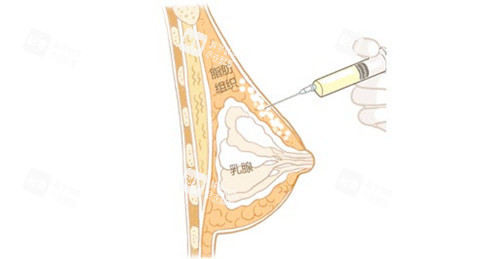 自体脂肪隆胸通图