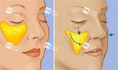 面部苹果肌提升前后对比