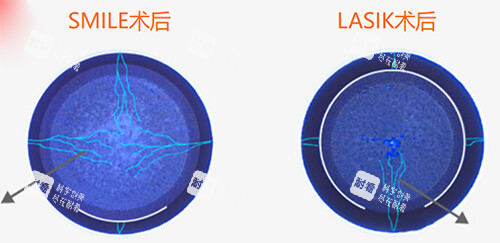 近视手术选哪家？张家口朝聚眼科价格表+真实病例分享，收藏这篇就够了