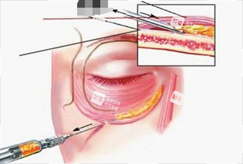 胶原蛋白注射眼部示意图