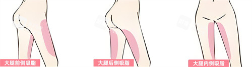 腿部吸脂部位展示动画图 腿部吸脂部位展示动画图