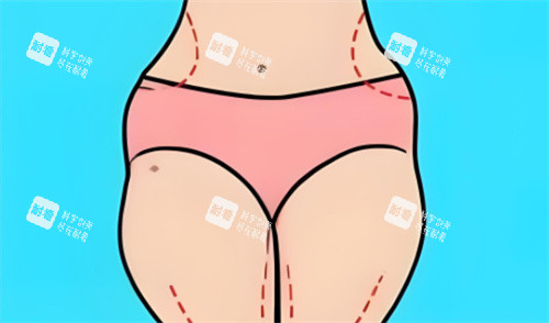 吸脂部位划线 吸脂部位划线