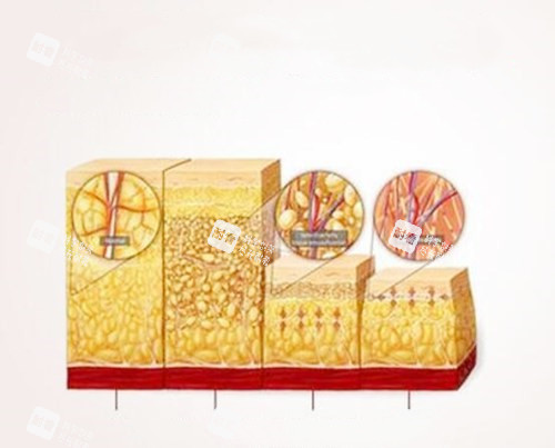 吸脂卡通图展示 吸脂卡通图展示