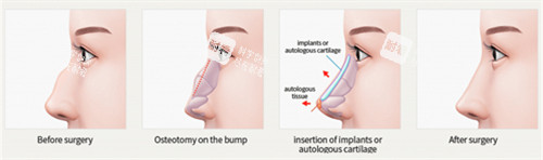 驼峰鼻矫正流程