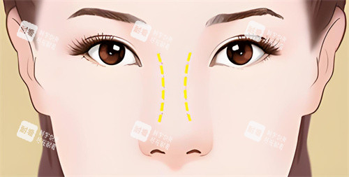 宽鼻矫正宣传图