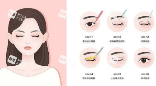 拉双眼皮手术示意图 拉双眼皮手术示意图