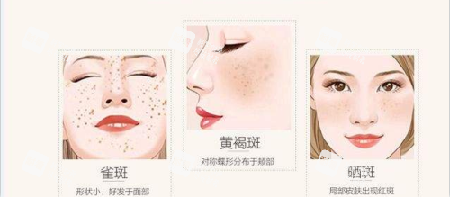 激光祛斑 激光祛斑