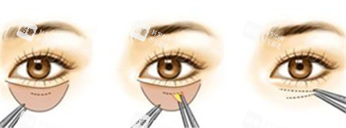 内切法祛眼袋的手术步骤