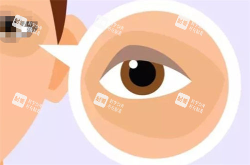 黑眼圈眼袋示意图