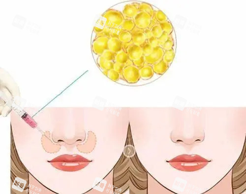 脂肪填充鼻基底位置示意图 脂肪填充鼻基底位置示意图