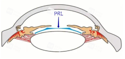 PRL晶体植入术放置位置 PRL晶体植入术放置位置