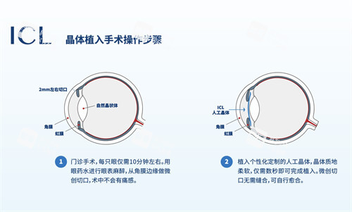 哈医大二院晶体植入价格2026：ICL/TICL/多焦点晶体费用明细，性价比分析！