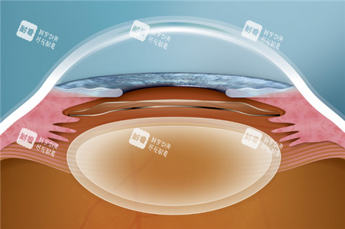 晶体植入手术动画图